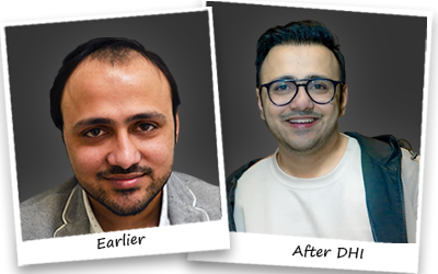 Hair Transplant in Chandigarh image