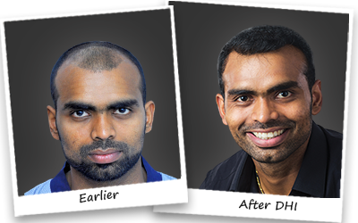 Hair Transplant in Chandigarh image