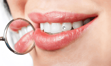 COSMODENT INDIA - INVISALIGN l DENTAL IMPLANTS l SMILE DESIGN l VENEERS l ORTHO BRACES l LASER RCTs l 3D SCANS and MUCH MORE image
