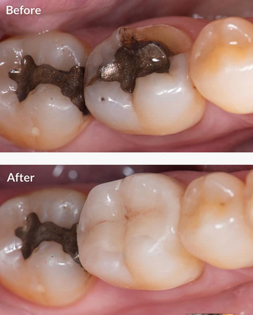 dental restoration of Smile Dental Care - Best Dental Care in Mysore