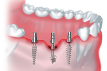 COSMODENT INDIA - INVISALIGN l DENTAL IMPLANTS l SMILE DESIGN l VENEERS l ORTHO BRACES l LASER RCTs l 3D SCANS and MUCH MORE image