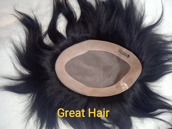 Hair Transplant of Hair Fixing world