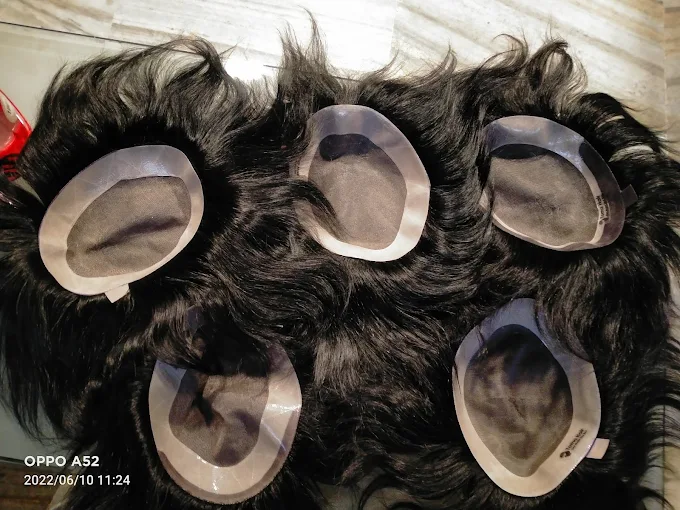 Hair Transplant of Hair Fixing world